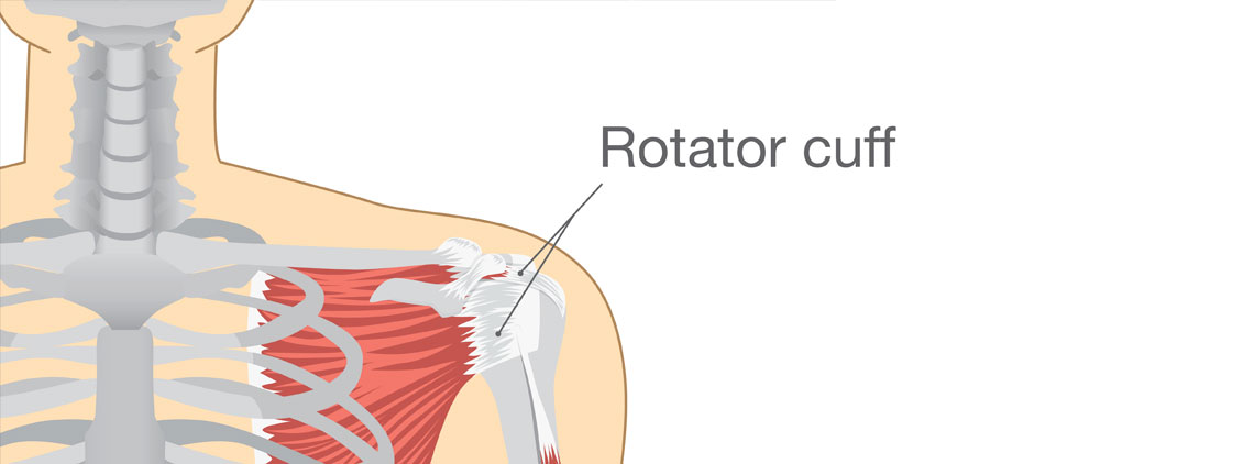Rotator Cuff Tear - Overview - Nonsurgical Options - Orlando Hand